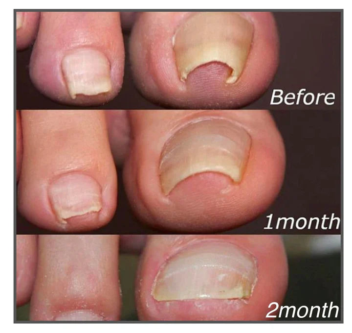 Corrective patches for healthy and beautiful nails 